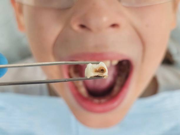 Best Dentist for Tooth Abscess  in Vail, CO